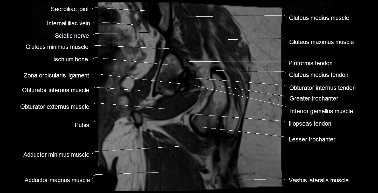 MRI Hip 3T coronal cross sectional anatomy image 41.webp